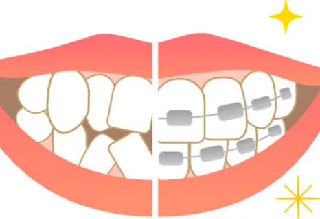 いろいろな歯並び